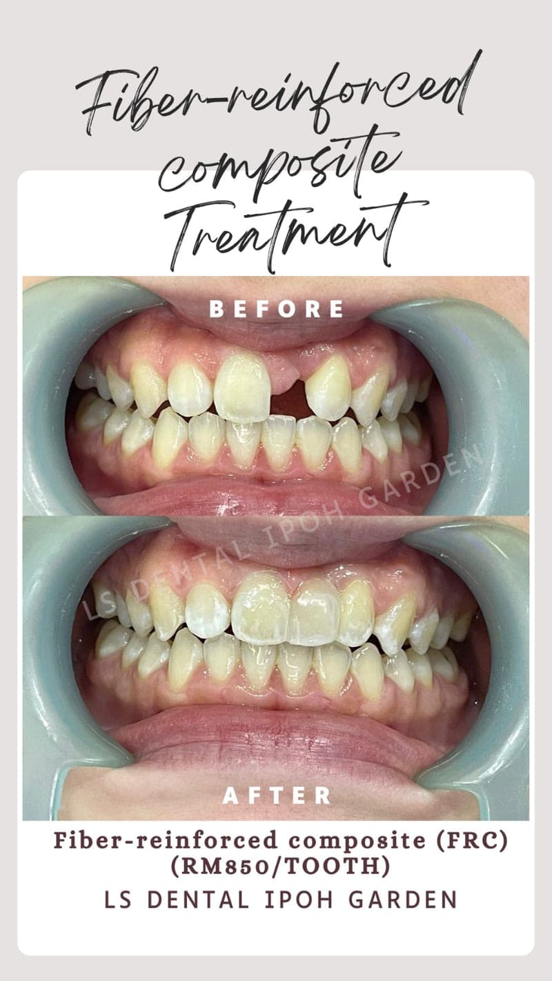 Fiber-Reinforced Composite Bridge — before and after, LS Dental Clinic Ipoh Garden