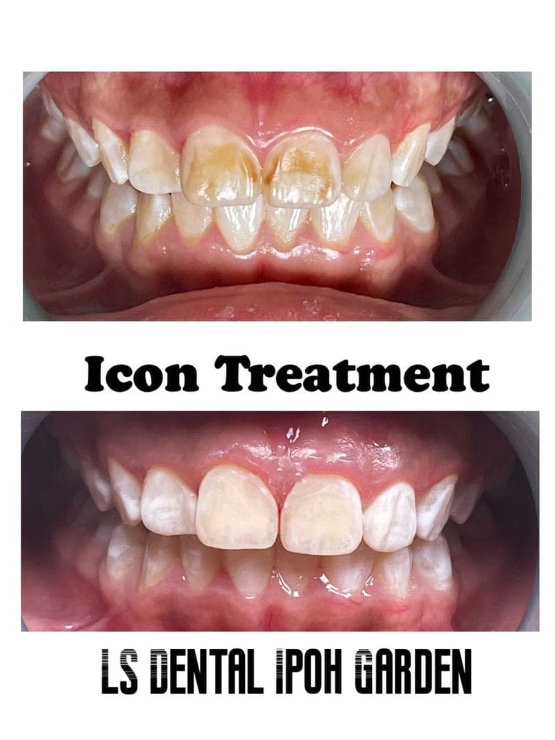 Icon — Fluorosis Treatment — before and after, LS Dental Clinic Ipoh Garden
