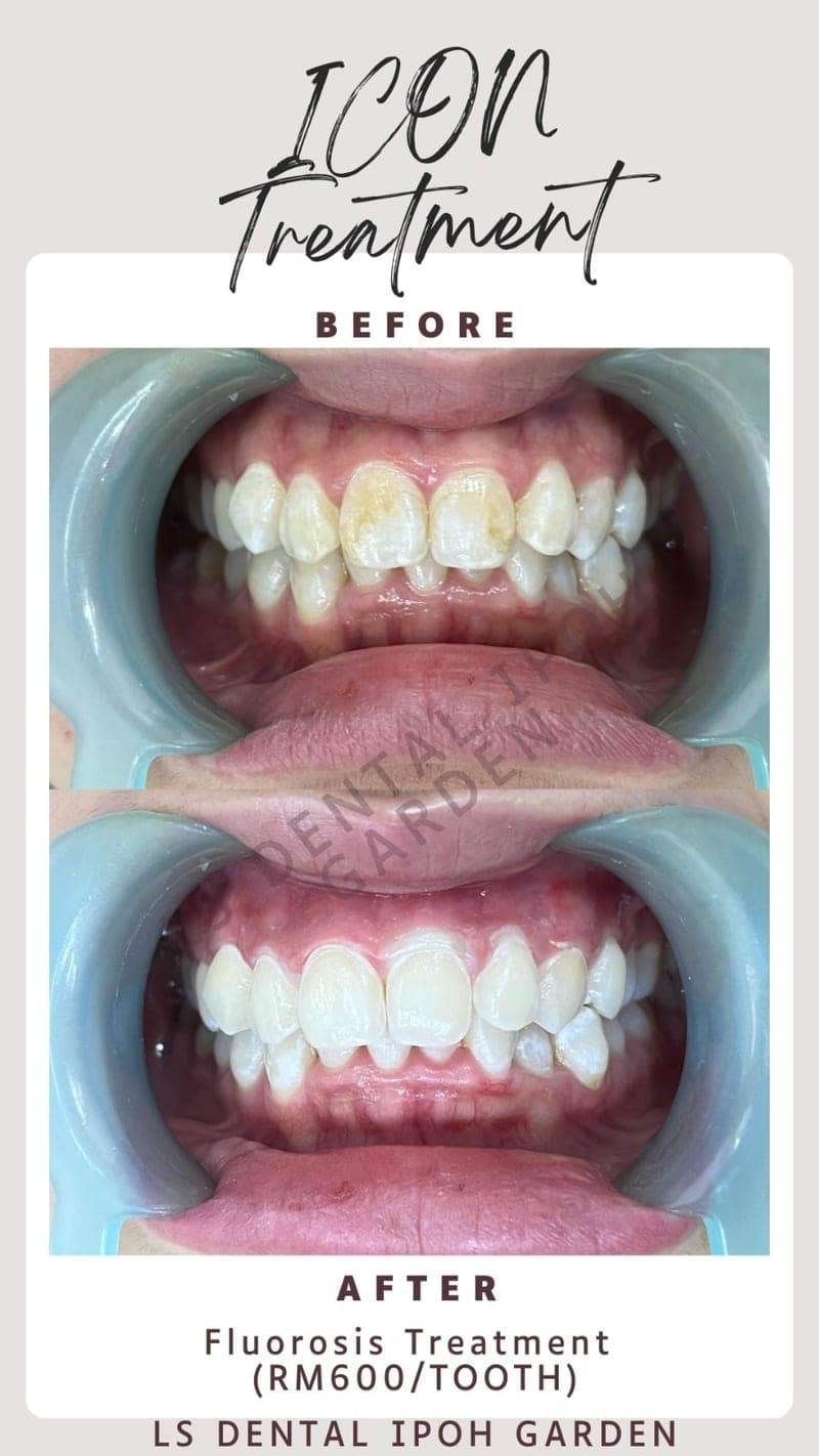 Icon — White Spot Treatment — before and after, LS Dental Clinic Ipoh Garden