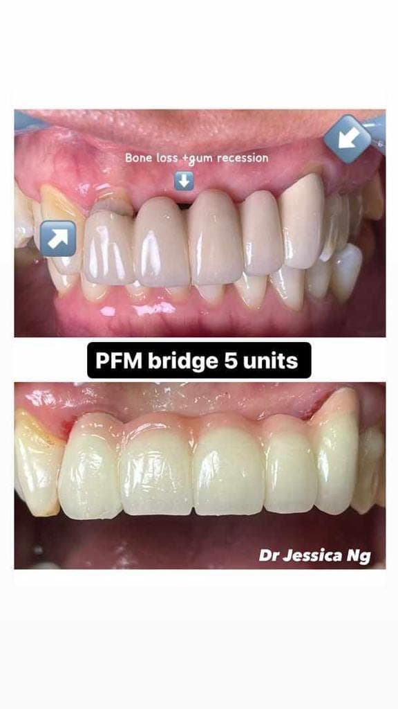 PFM Bridge (5 Units) — before and after, LS Dental Clinic Ipoh Garden