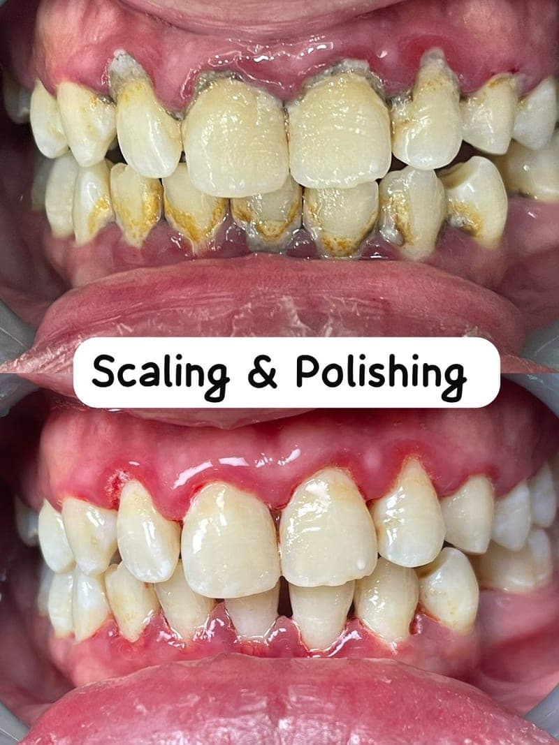 Scaling & Polishing — before and after, LS Dental Clinic Ipoh Garden