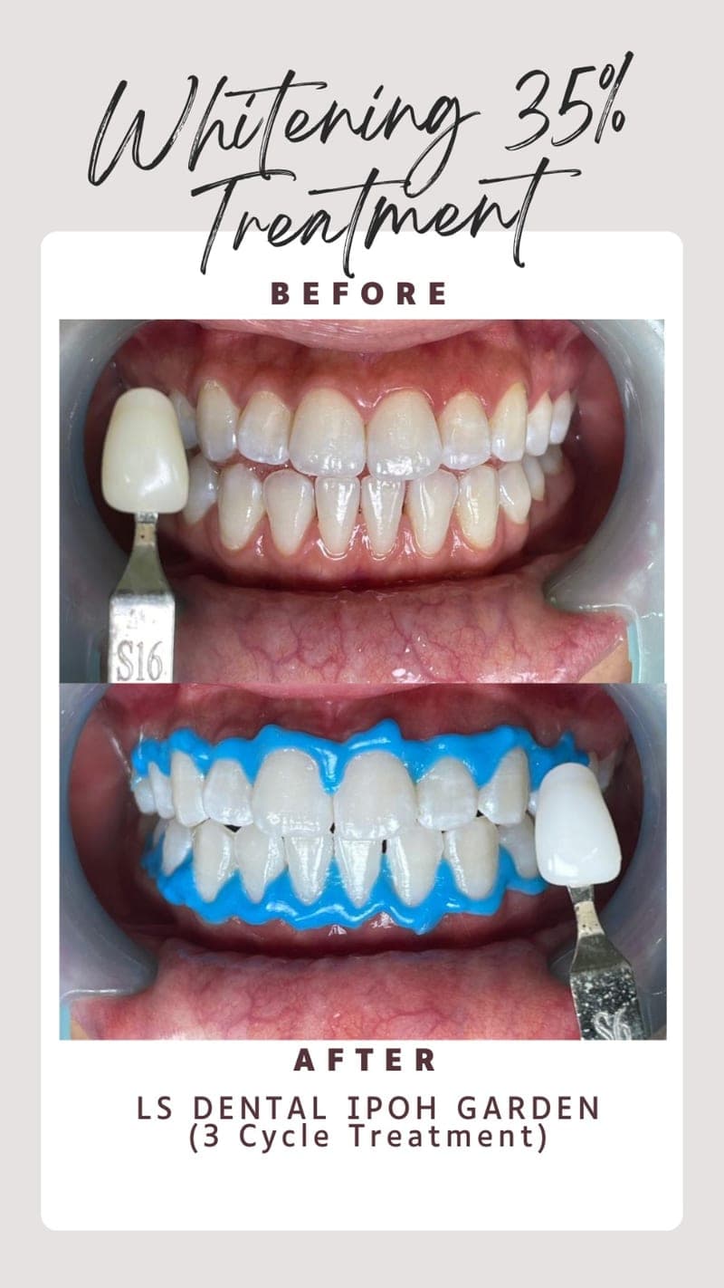 Teeth Whitening (3-Cycle) — before and after, LS Dental Clinic Ipoh Garden