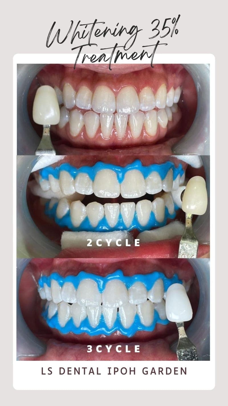 Teeth Whitening (35%) — before and after, LS Dental Clinic Ipoh Garden