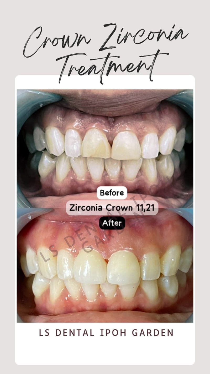 Zirconia Crown — before and after, LS Dental Clinic Ipoh Garden