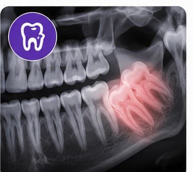 Wisdom Tooth